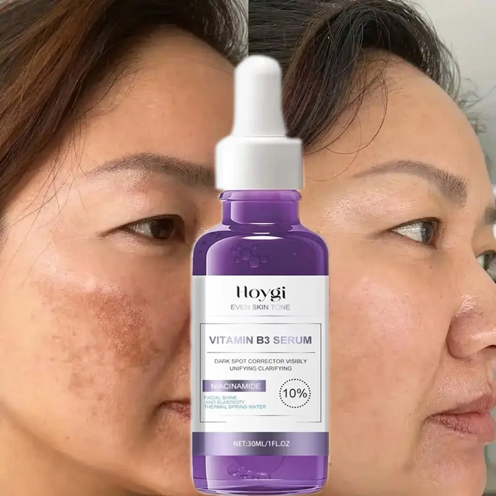Powerful Dark Spots Remover Freckle Whitening Serum Melanin Correcting Anti Pigmentation
